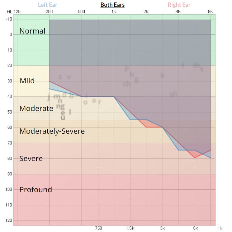 Audiogram example