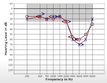 Pure noise induced hearing loss